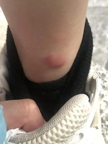 被不懂什么咬了 起了这么大个包