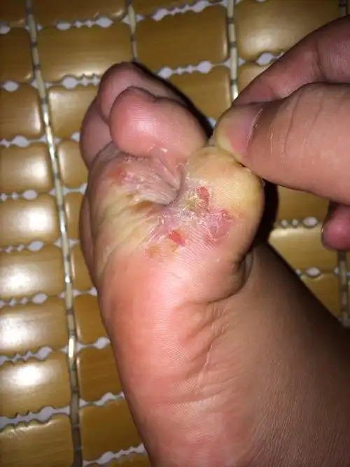 脚烂成这样怎么办?