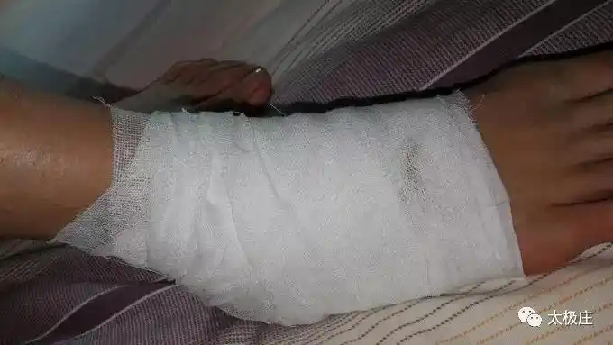 我用黄栀子粉为女儿治脚踝扭伤