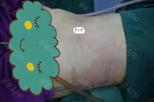 吸脂瘦腰腹怎么样_恢复过程_效果如何_氧气1ry1v整形日记1.