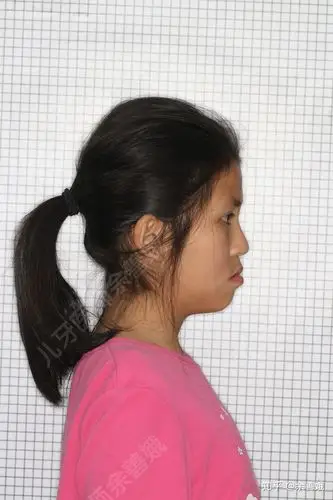 这位小女孩今年12岁了,是典型的地包天,之前去过很多口腔机构咨询