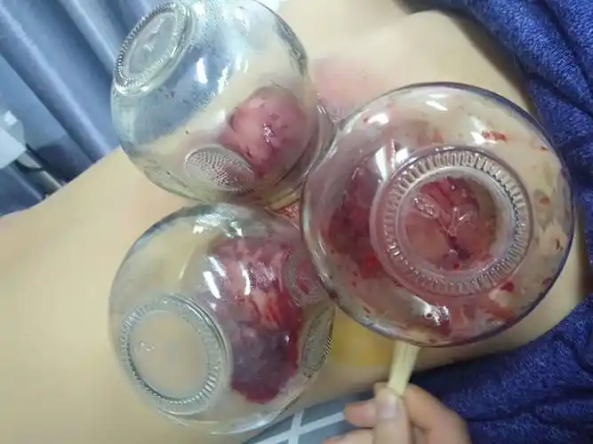 刺络放血拔罐治疗腰背疼痛