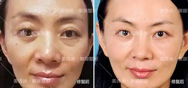 美诗沁眼袋失败修复真人案例对比照