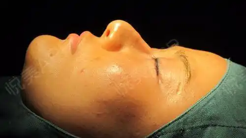 鼻综合手术当天_隆鼻失败修复手术当天_鼻小柱延长手术当天_鼻头&鼻翼