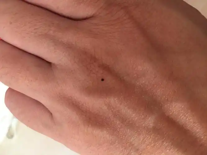 手上突然出现个小黑点,跟圆珠笔尖一样大小,有点凸起,不痛不痒,有知道