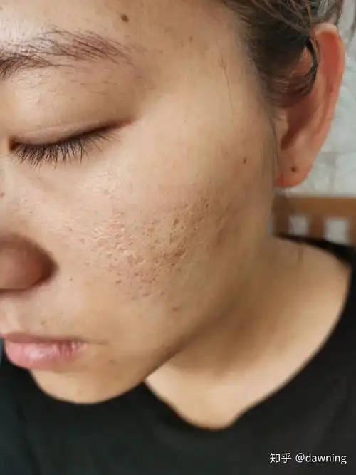 这样的痘坑如何改善