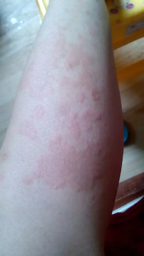 我想知道我长了什么东西,去医院说是过敏,买药吃了又查药了不是没好