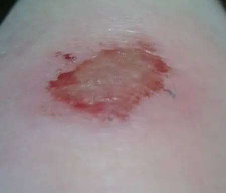 问:膝盖擦伤伤口变成这样是化脓了么