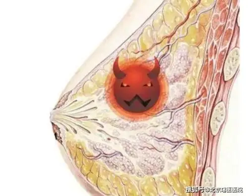 自己如何分辨乳腺结节是良性还是恶性?