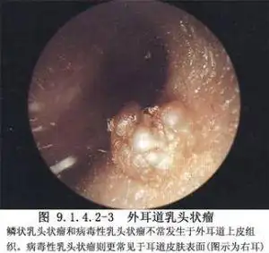 外耳恶性肿瘤手术术中注意事项耳廓和外耳道皮下组织致密,癌肿皮下