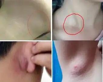 淋巴结肿大的原因儿童淋巴结肿大怎么消除