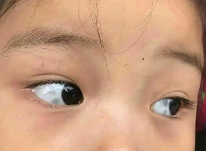 眼白出现这几种颜色,你该警惕了!