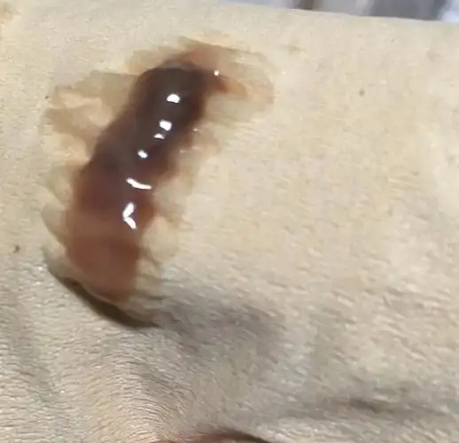 这个是啥呀棕褐色白带为什么是这种颜色求解