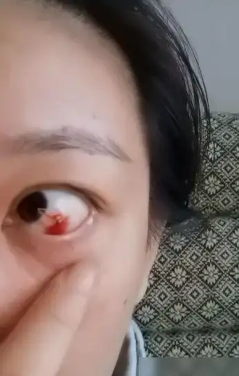 唐一菲与谢娜再度同台合作,节目录制完却将眼睛哭出了血,这是得多用力