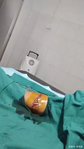 7月20号做的缝合手术