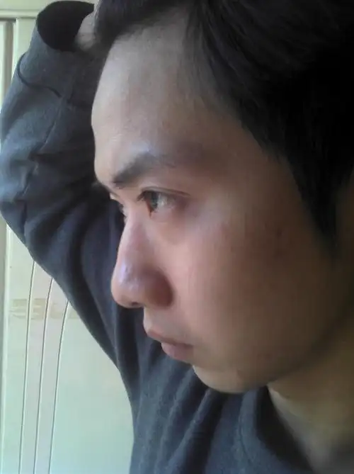 额头凸出,额头上有两个包是怎么回事?有图,.