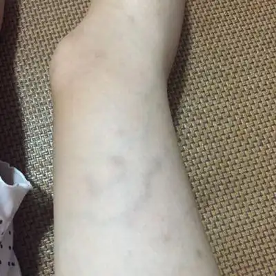 孕中期开始 我的大腿就开始静脉曲张 还有好几处有红血丝 怎麼办