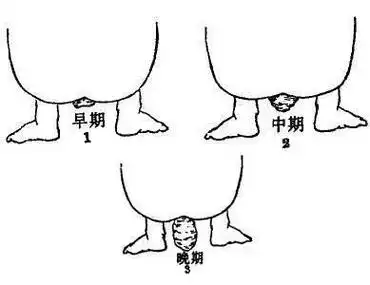 直肠脱垂是种什么体验