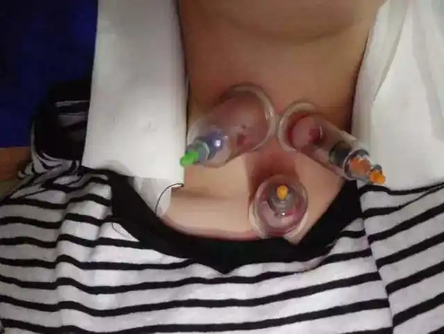 娱乐圈掀起"拔罐风",不止杨幂邓伦,连美国甜心都沦陷了