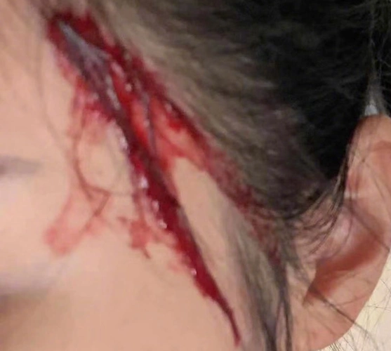 网曝徐冬冬片场拍戏受伤 额头侧面流血险些失明