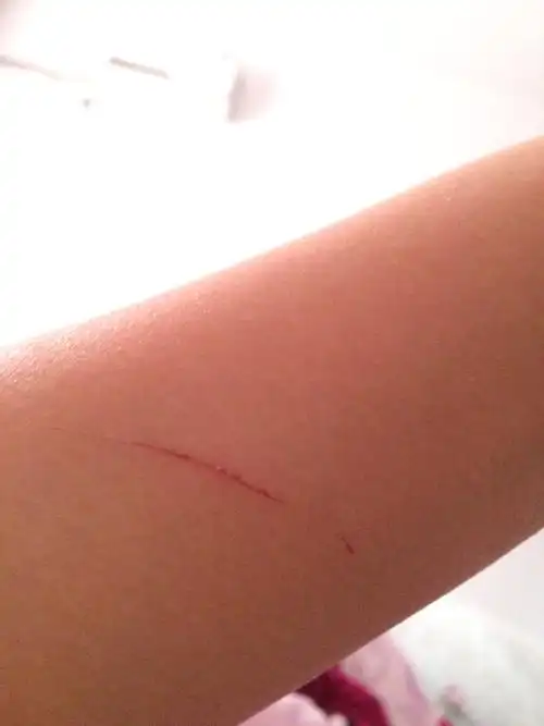 请问我是被家里的猫爪子抓了一下,但是猫咪没打针,成了这样,医院医生