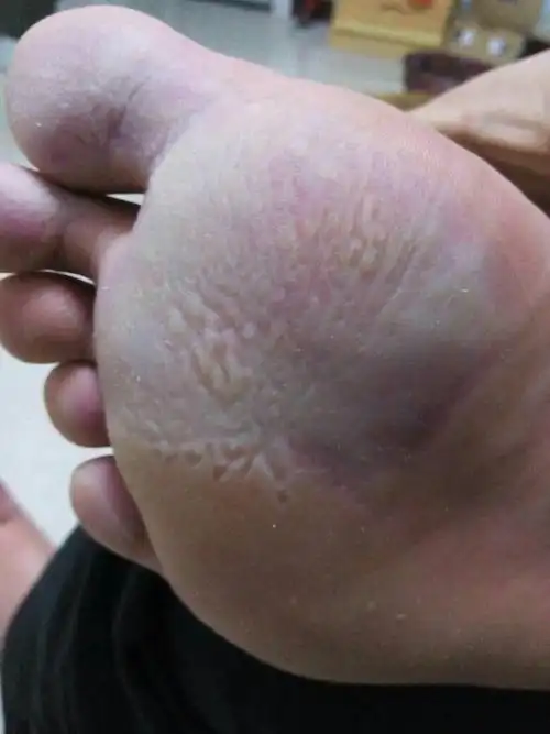 前脚掌遇水或者汗发白,而且出汗不易干!很大的臭味!不疼不痒!