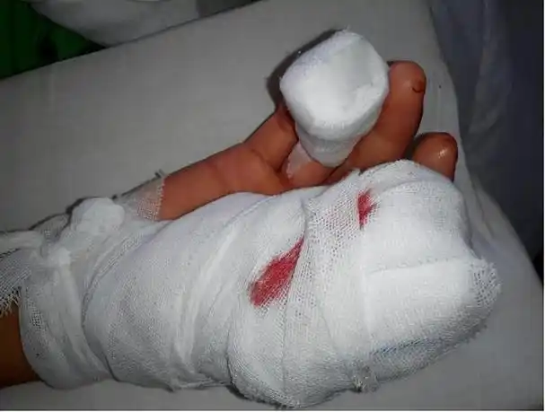 法律意义上的轻伤有多严重?|过失|轻微伤|命根子_网易订阅