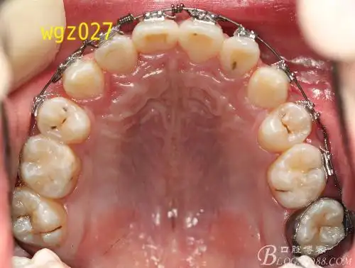 一例腭侧错位侧切牙的正畸治疗