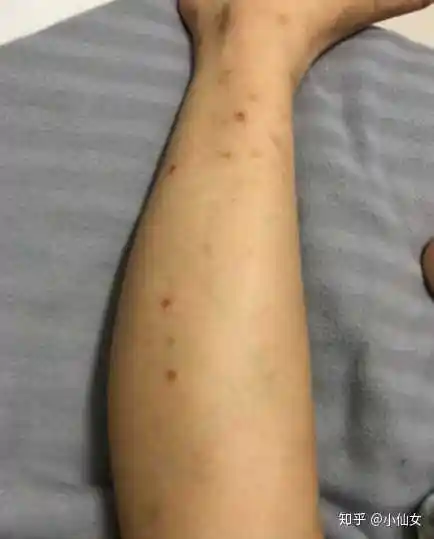 怎么去除被蚊子咬留下的黑疤?