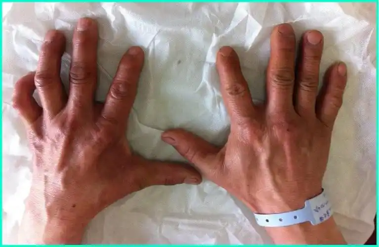 肘管综合征的治疗与防治_肘管综合征_介绍_症状表现_如何预防_治疗