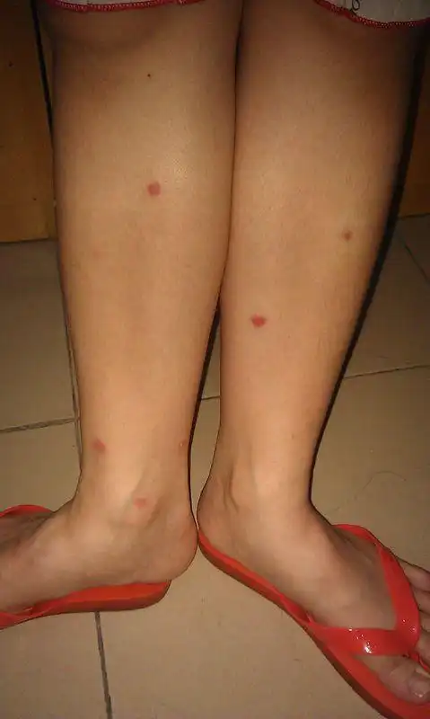 先是背上长了十几个包,去医院看,医生就瞧了五秒钟不到就说是螨虫咬.