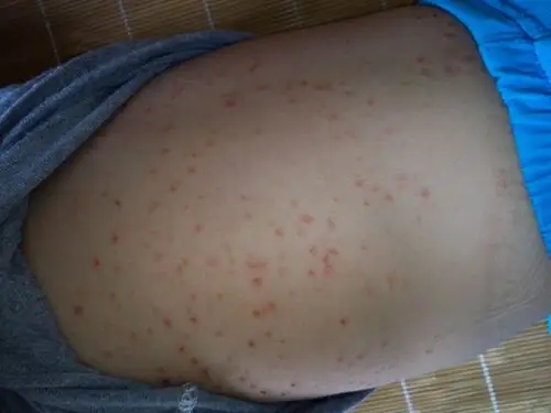 我家一岁半宝宝身上长满红色有浓点包包