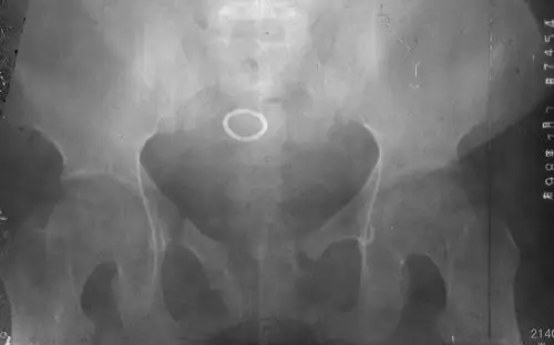 典型骨质软化症