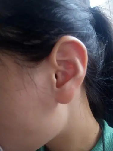 我耳垂很大也很厚,现在是夏天,我想打耳洞,请问打在哪里比较好在线求